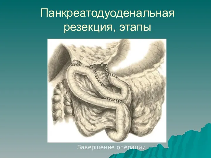 Панкреатодуоденальная резекция, этапы Завершение операции