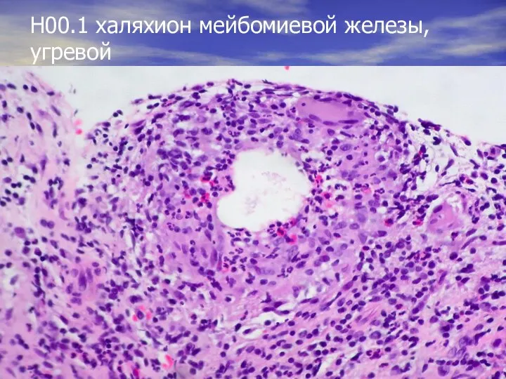 Н00.1 халяхион мейбомиевой железы,угревой