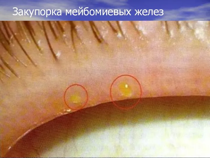 Закупорка мейбомиевых желез