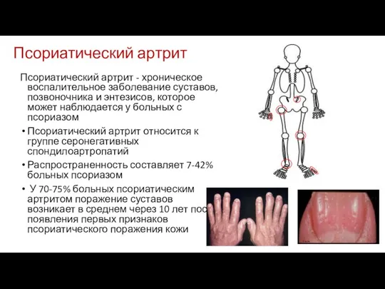 Псориатический артрит - хроническое воспалительное заболевание суставов, позвоночника и энтезисов, которое