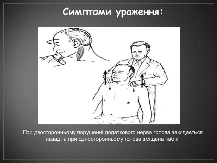 Симптоми ураження: При двосторонньому порушенні додаткового нерва голова закидається назад, а при односторонньому голова зміщена набік.