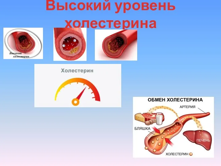 Высокий уровень холестерина