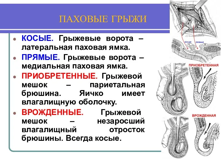 ПАХОВЫЕ ГРЫЖИ КОСЫЕ. Грыжевые ворота – латеральная паховая ямка. ПРЯМЫЕ. Грыжевые