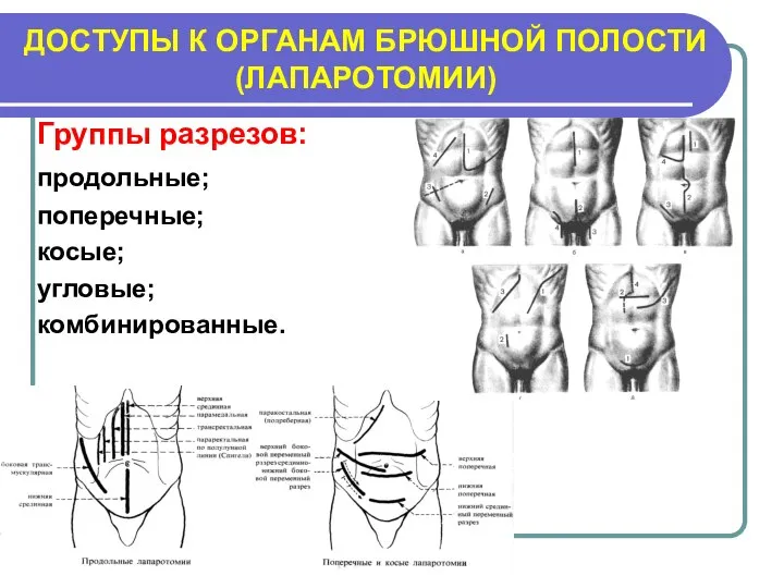 ДОСТУПЫ К ОРГАНАМ БРЮШНОЙ ПОЛОСТИ (ЛАПАРОТОМИИ) Группы разрезов: продольные; поперечные; косые; угловые; комбинированные.