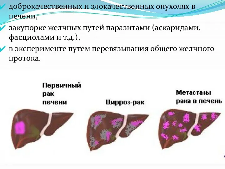 доброкачественных и злокачественных опухолях в печени, закупорке желчных путей паразитами (аскаридами,