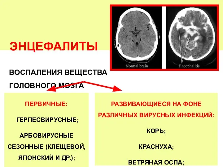 ЭНЦЕФАЛИТЫ ВОСПАЛЕНИЯ ВЕЩЕСТВА ГОЛОВНОГО МОЗГА ПЕРВИЧНЫЕ: ГЕРПЕСВИРУСНЫЕ; АРБОВИРУСНЫЕ СЕЗОННЫЕ (КЛЕЩЕВОЙ, ЯПОНСКИЙ