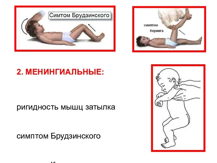 2. МЕНИНГИАЛЬНЫЕ: ригидность мышц затылка симптом Брудзинского симптом Кернига симптом Лессажа