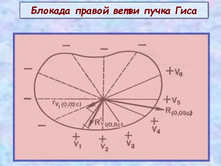 Блокада правой ветви пучка Гиса