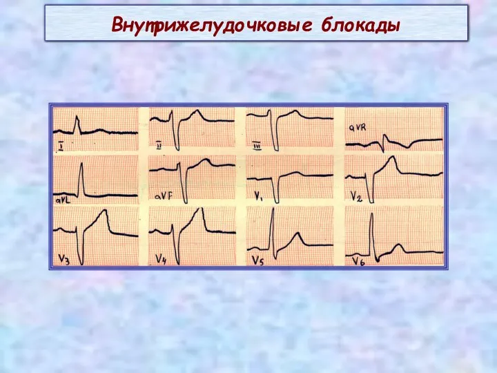 Внутрижелудочковые блокады