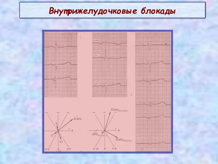 Внутрижелудочковые блокады