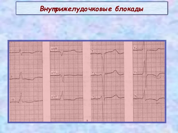 Внутрижелудочковые блокады