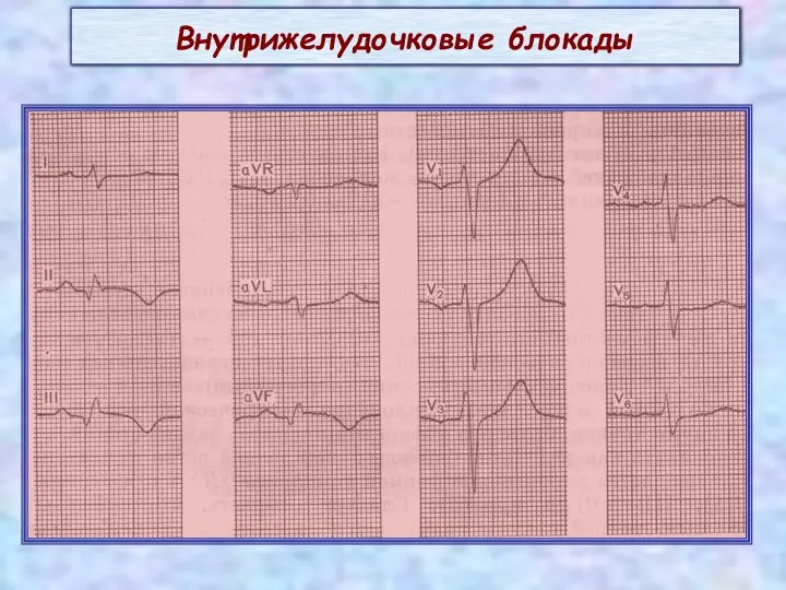 Внутрижелудочковые блокады