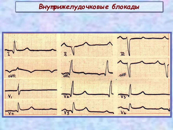 Внутрижелудочковые блокады