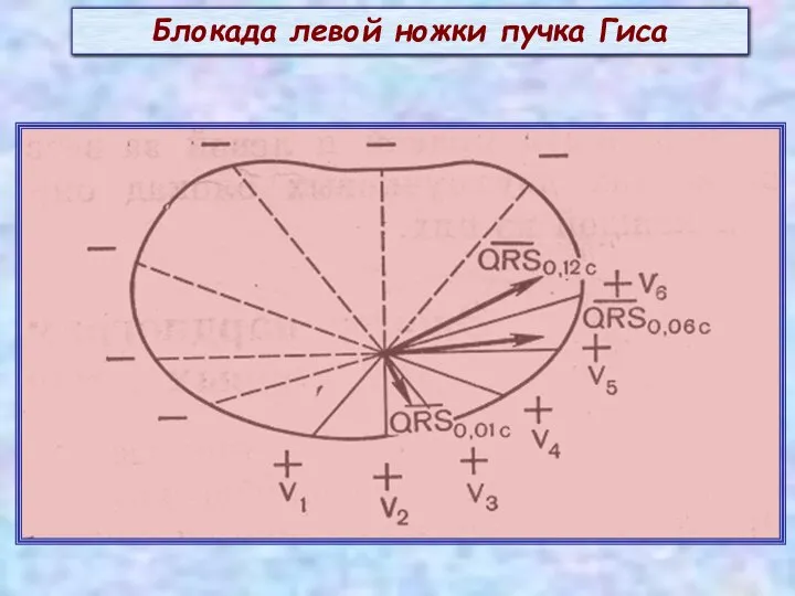 Блокада левой ножки пучка Гиса