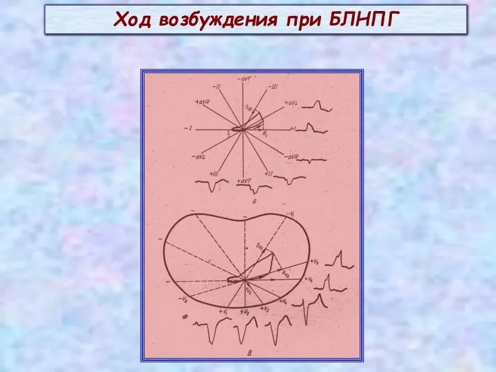 Ход возбуждения при БЛНПГ