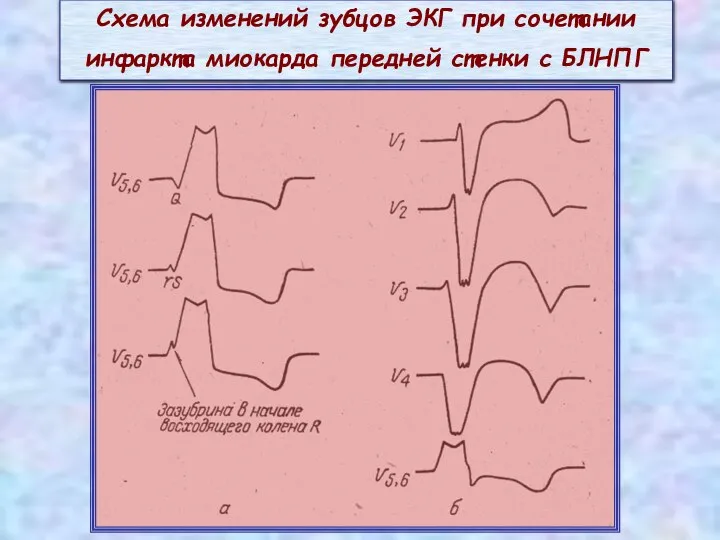 Схема изменений зубцов ЭКГ при сочетании инфаркта миокарда передней стенки с БЛНПГ