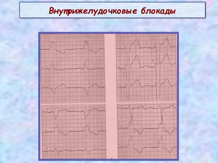 Внутрижелудочковые блокады