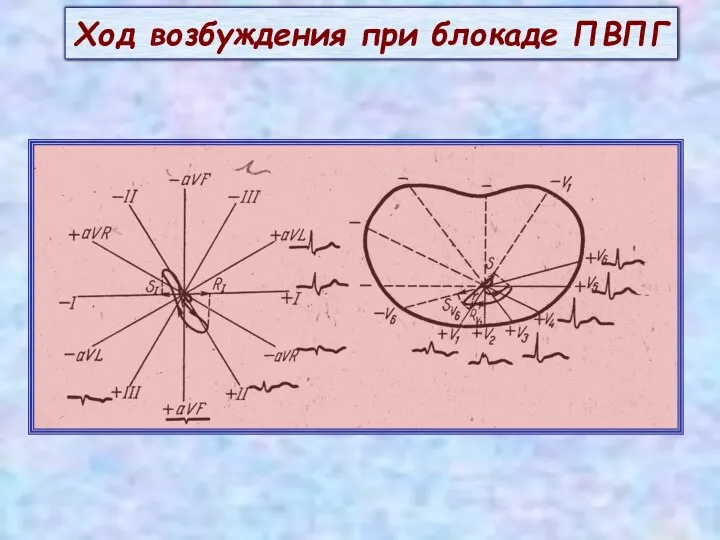 Ход возбуждения при блокаде ПВПГ