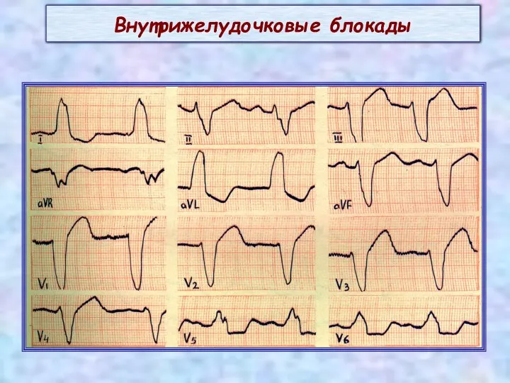 Внутрижелудочковые блокады