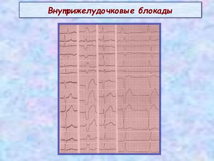 Внутрижелудочковые блокады