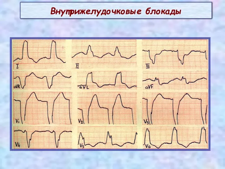 Внутрижелудочковые блокады