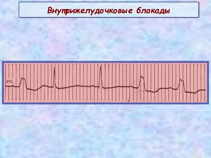 Внутрижелудочковые блокады