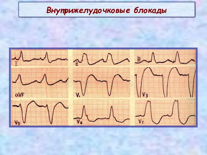 Внутрижелудочковые блокады