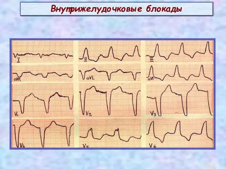 Внутрижелудочковые блокады