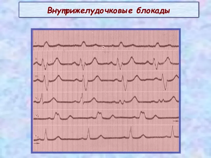 Внутрижелудочковые блокады