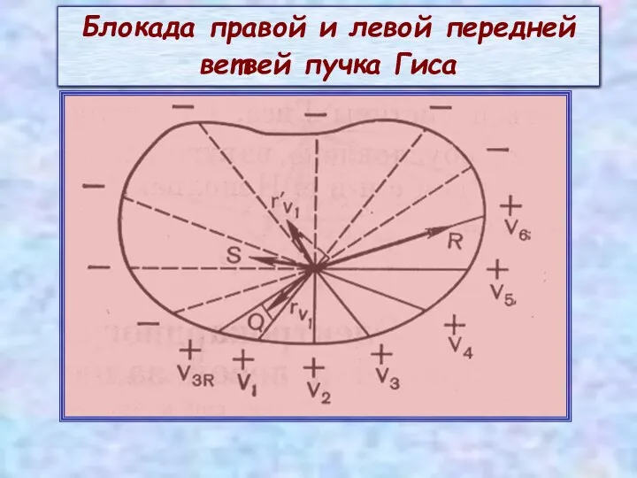 Блокада правой и левой передней ветвей пучка Гиса