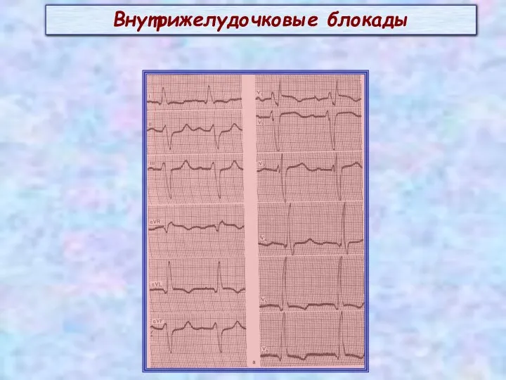 Внутрижелудочковые блокады