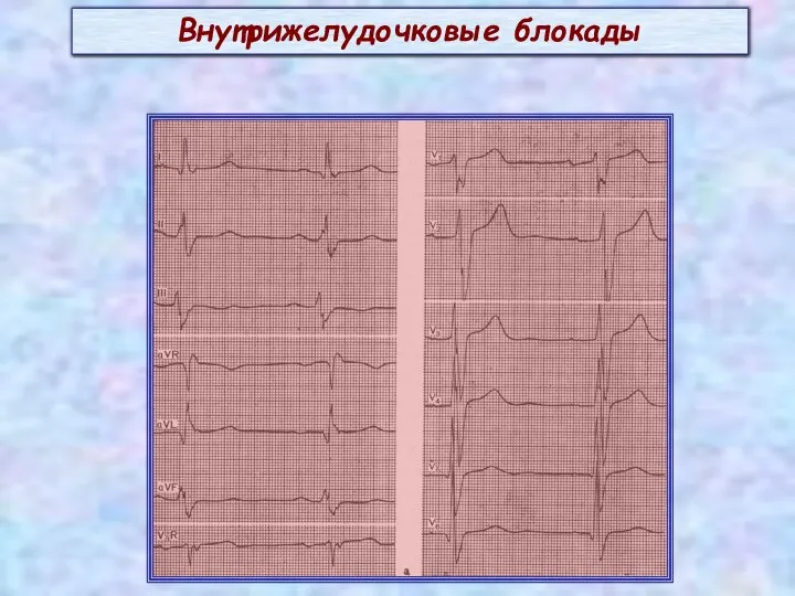 Внутрижелудочковые блокады