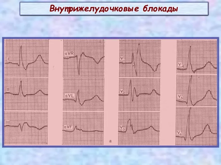 Внутрижелудочковые блокады