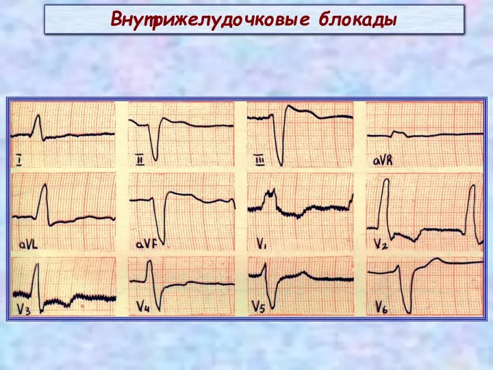 Внутрижелудочковые блокады