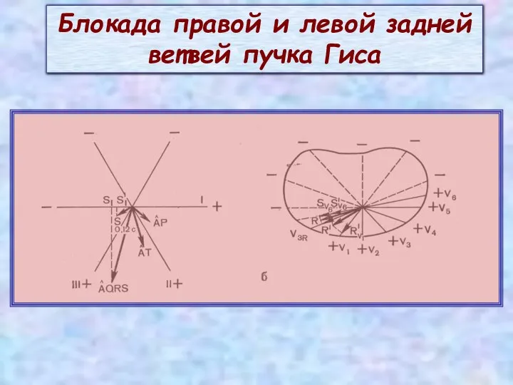 Блокада правой и левой задней ветвей пучка Гиса