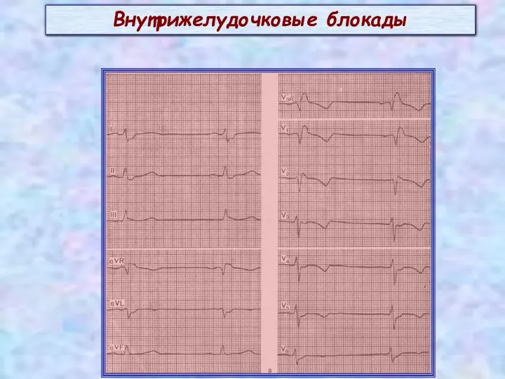 Внутрижелудочковые блокады