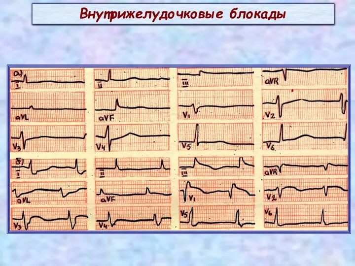 Внутрижелудочковые блокады