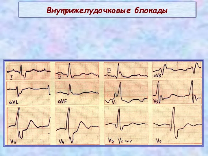 Внутрижелудочковые блокады