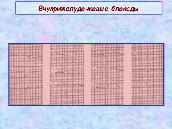 Внутрижелудочковые блокады