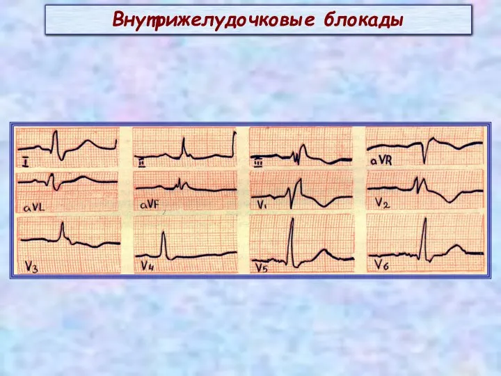 Внутрижелудочковые блокады