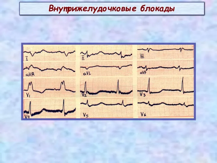 Внутрижелудочковые блокады