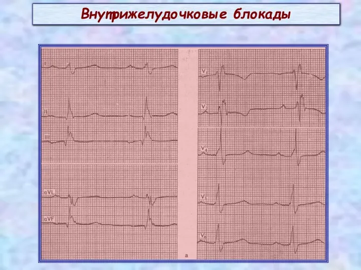 Внутрижелудочковые блокады