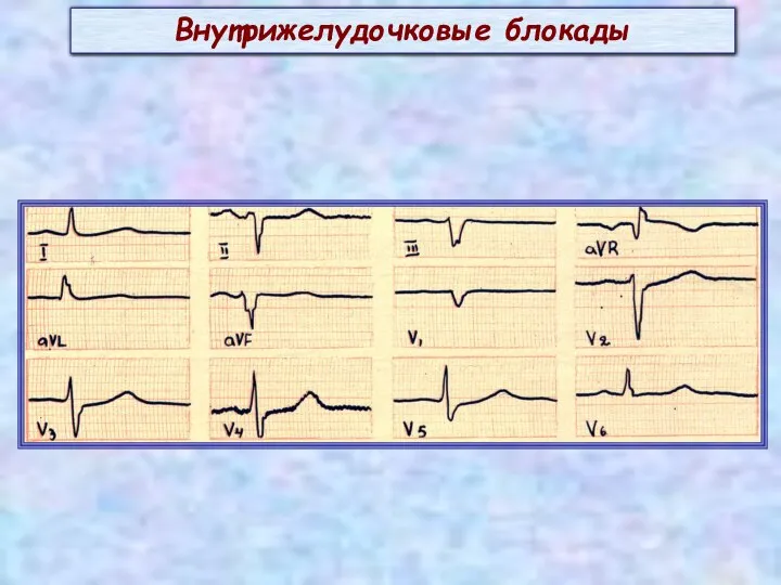 Внутрижелудочковые блокады