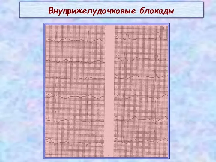 Внутрижелудочковые блокады