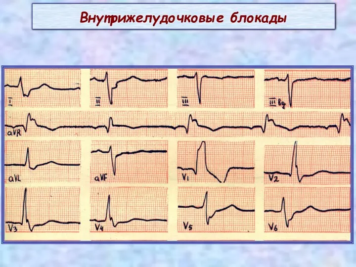 Внутрижелудочковые блокады