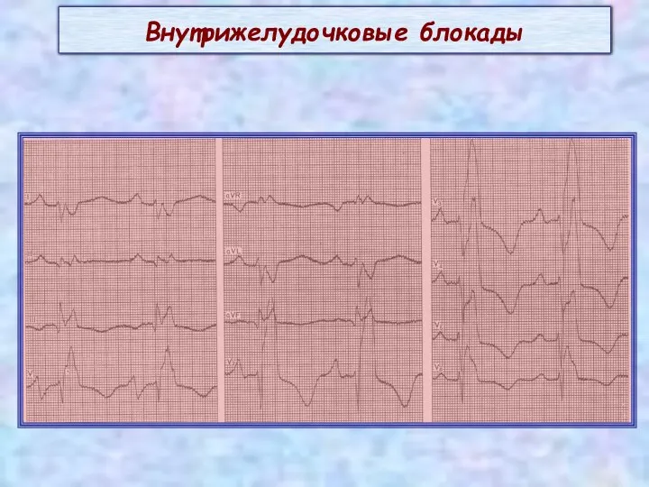 Внутрижелудочковые блокады