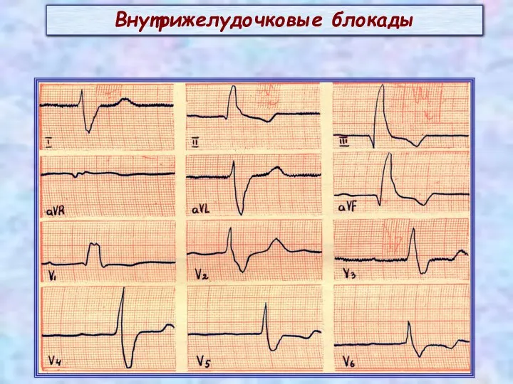 Внутрижелудочковые блокады