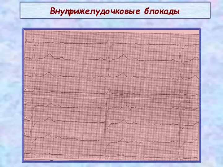 Внутрижелудочковые блокады