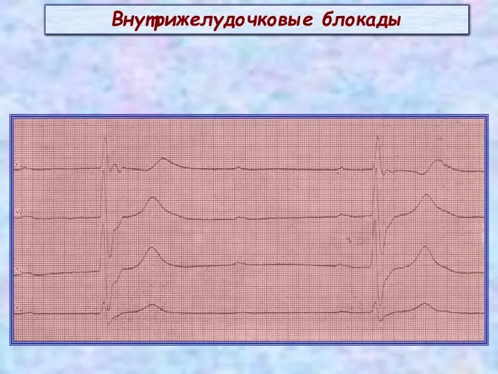 Внутрижелудочковые блокады