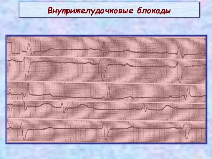 Внутрижелудочковые блокады